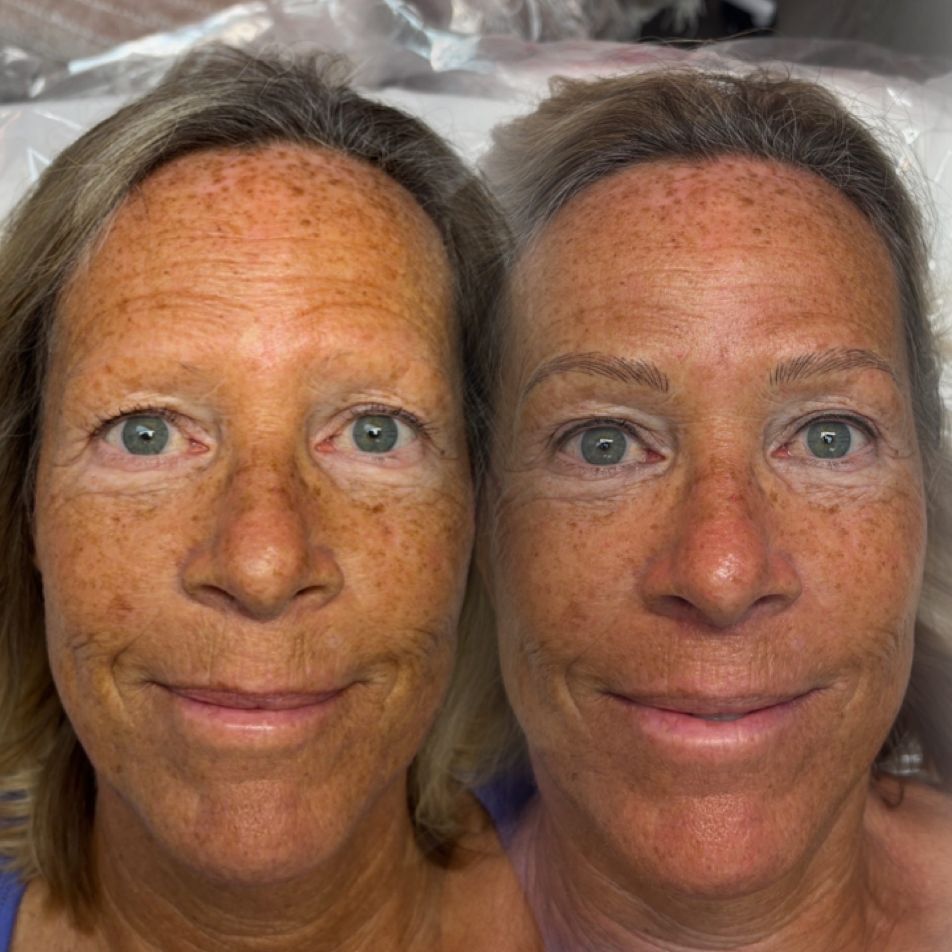 Full-face brow transformation before and after